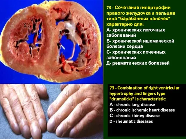73 - Сочетание гипертрофии правого желудочка и пальцев типа "барабанных палочек"
