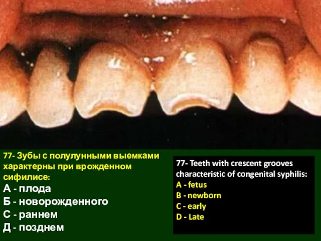 77- Зубы с полулунными выемками характерны при врожденном сифилисе: А -
