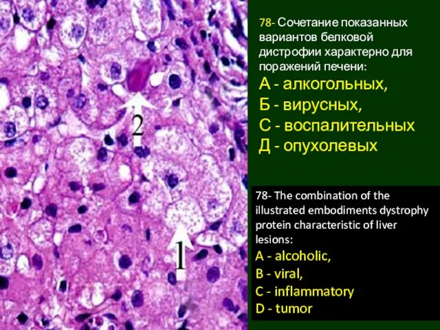 78- Сочетание показанных вариантов белковой дистрофии характерно для поражений печени: А