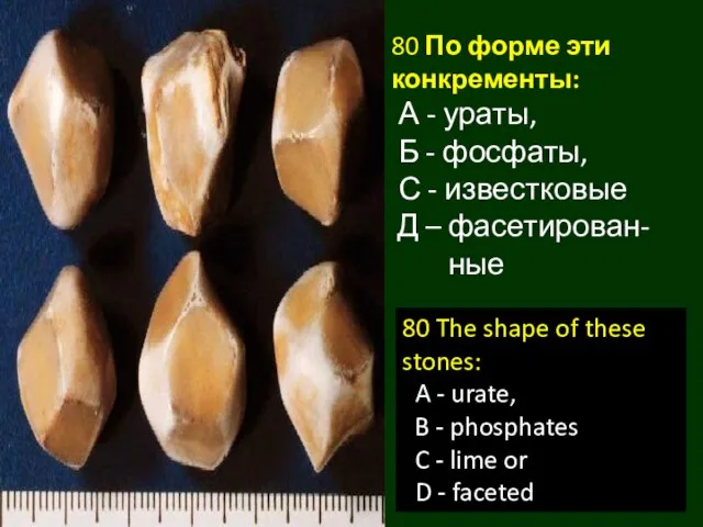 80 По форме эти конкременты: А - ураты, Б - фосфаты,