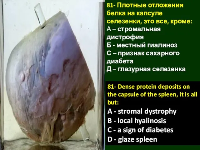 81- Плотные отложения белка на капсуле селезенки, это все, кроме: А