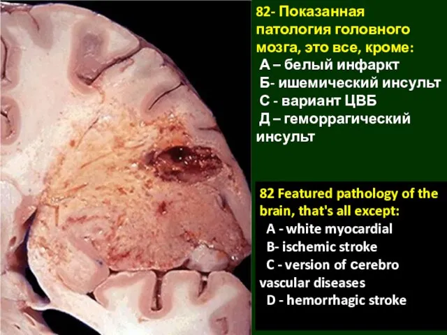82- Показанная патология головного мозга, это все, кроме: А – белый