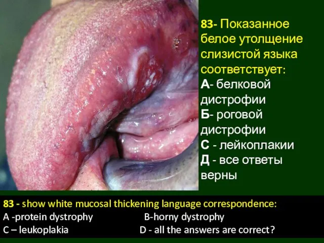 83- Показанное белое утолщение слизистой языка соответствует: А- белковой дистрофии Б-