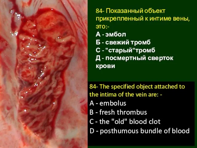 84- Показанный объект прикрепленный к интиме вены, это:- А - эмбол