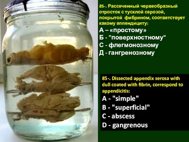 85-. Рассеченный червеобразный отросток с тусклой серозой, покрытой фибрином, соответствует какому