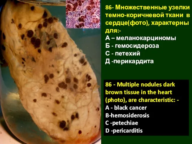 86- Множественные узелки темно-коричневой ткани в сердце(фото), характерны для:- А –