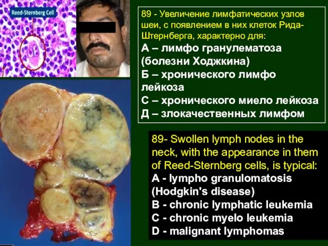 89 - Увеличение лимфатических узлов шеи, с появлением в них клеток