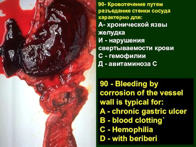 90- Кровотечение путем разъедания стенки сосуда характерно для: А- хронической язвы