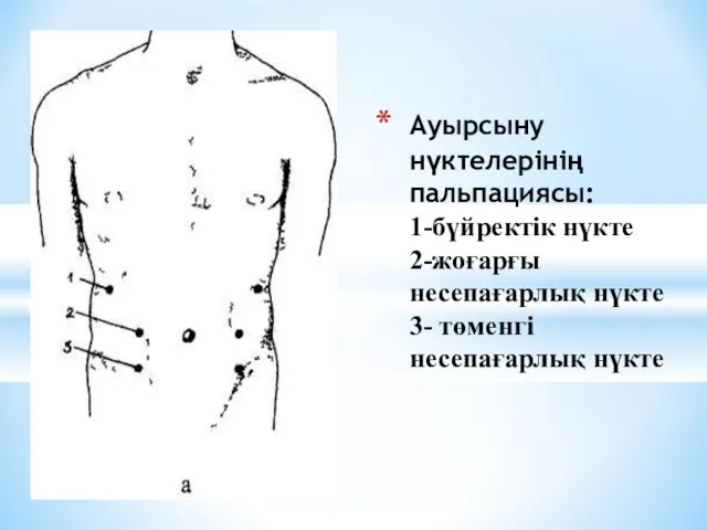 Ауырсыну нүктелерінің пальпациясы: 1-бүйректік нүкте 2-жоғарғы несепағарлық нүкте 3- төменгі несепағарлық нүкте