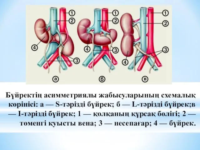 Бүйректің асимметриялы жабысуларының схемалық көрінісі: а — S-тәрізді бүйрек; б —