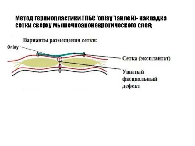 Метод герниопластики ГПБС 'onlay”(анлей)- накладка сетки сверху мышечноапоневротического слоя;