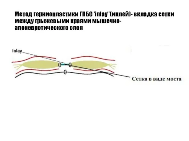 Метод герниопластики ГПБС 'inlay”(инлей)- вкладка сетки между грыжевыми краями мышечно-апоневротического слоя