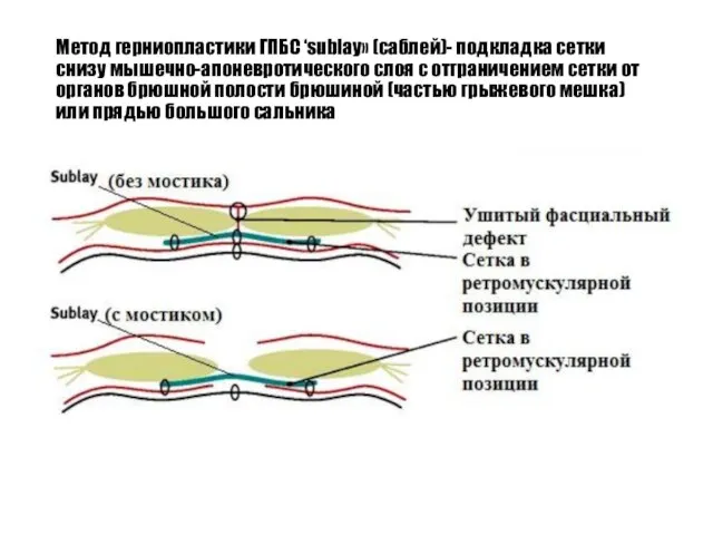 Метод герниопластики ГПБС ‘sublay» (саблей)- подкладка сетки снизу мышечно-апоневротического слоя с