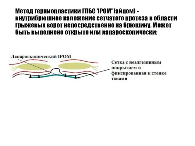 Метод герниопластики ГПБС 'IPOM”(айпом) - внутрибрюшное наложение сетчатого протеза в области