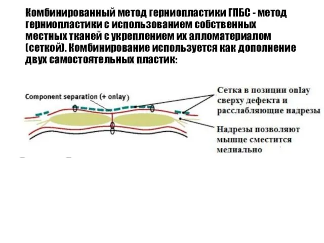 Комбинированный метод герниопластики ГПБС - метод герниопластики с использованием собственных местных