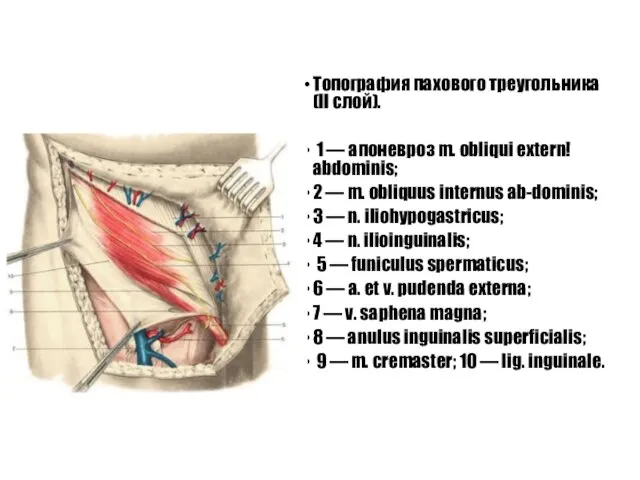 Топография пахового треугольника (II слой). 1 — апоневроз m. obliqui extern!