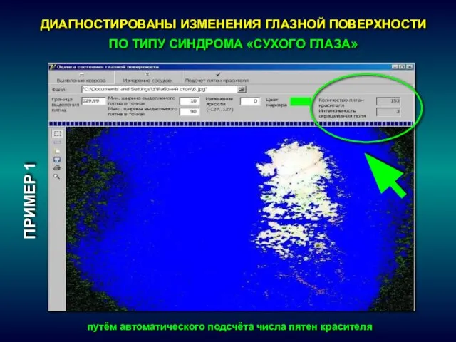 ПРИМЕР 1 ДИАГНОСТИРОВАНЫ ИЗМЕНЕНИЯ ГЛАЗНОЙ ПОВЕРХНОСТИ ПО ТИПУ СИНДРОМА «СУХОГО ГЛАЗА»