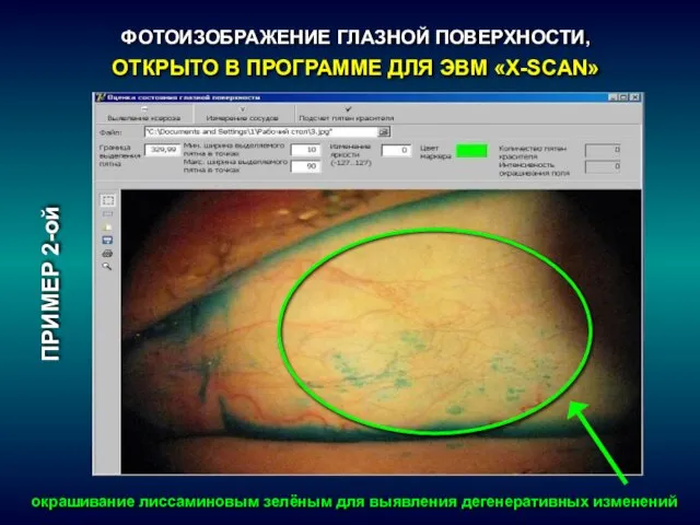 ПРИМЕР 2-ой ФОТОИЗОБРАЖЕНИЕ ГЛАЗНОЙ ПОВЕРХНОСТИ, ОТКРЫТО В ПРОГРАММЕ ДЛЯ ЭВМ «X-SCAN»