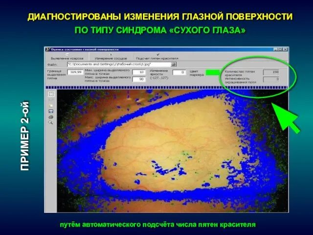 ПРИМЕР 2-ой ДИАГНОСТИРОВАНЫ ИЗМЕНЕНИЯ ГЛАЗНОЙ ПОВЕРХНОСТИ ПО ТИПУ СИНДРОМА «СУХОГО ГЛАЗА»