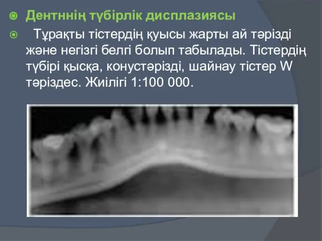 Дентннің түбірлік дисплазиясы Тұрақты тістердің қуысы жарты ай тәрізді және негізгі