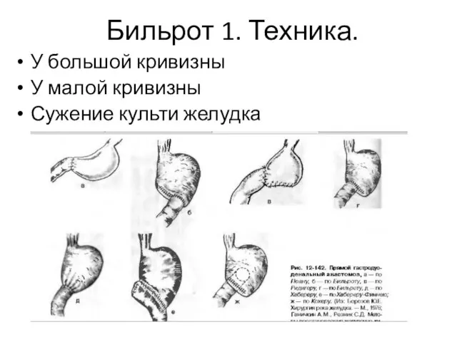 Бильрот 1. Техника. У большой кривизны У малой кривизны Сужение культи желудка