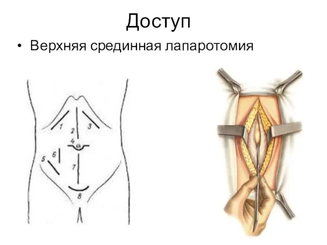 Доступ Верхняя срединная лапаротомия