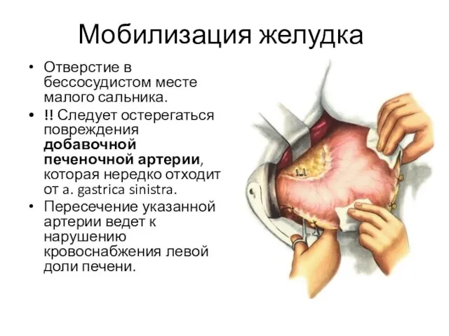 Мобилизация желудка Отверстие в бессосудистом месте малого сальника. !! Следует остерегаться