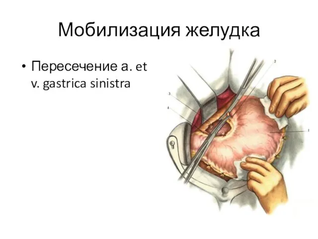 Мобилизация желудка Пересечение а. et v. gastrica sinistra