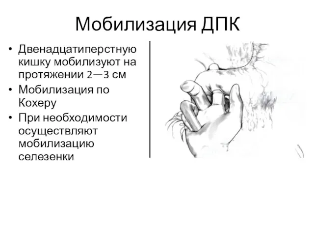 Мобилизация ДПК Двенадцатиперстную кишку мобилизуют на протяжении 2—3 см Мобилизация по