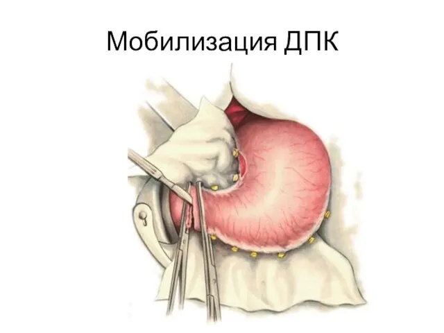 Мобилизация ДПК