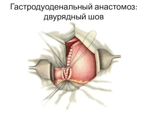 Гастродуоденальный анастомоз: двурядный шов