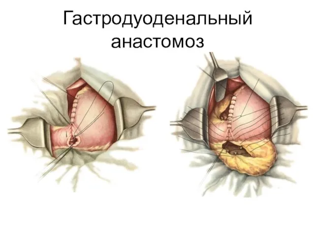 Гастродуоденальный анастомоз