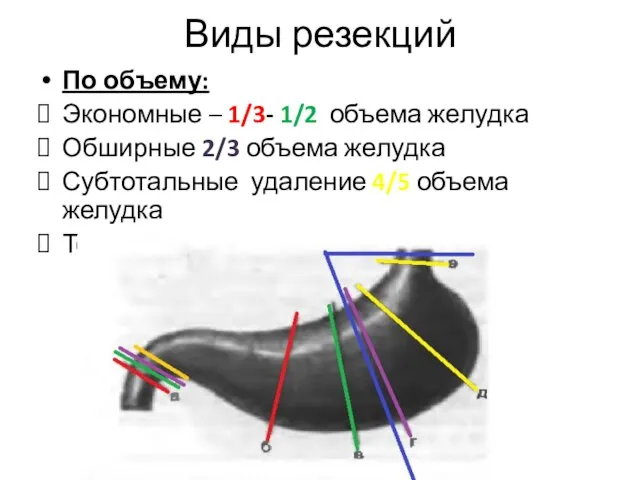 Виды резекций По объему: Экономные – 1/3- 1/2 объема желудка Обширные