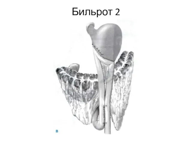 Бильрот 2