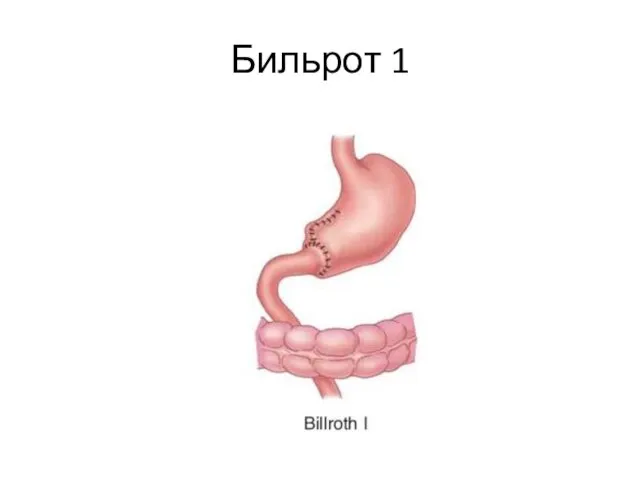 Бильрот 1