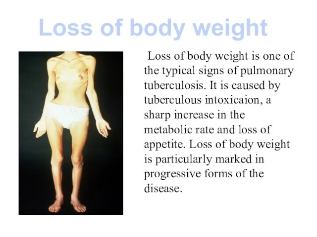 Loss of body weight is one of the typical signs of