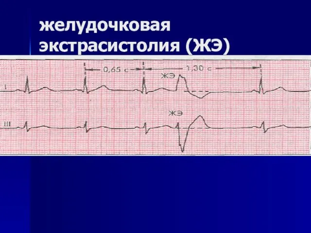 желудочковая экстрасистолия (ЖЭ)