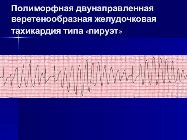 Полиморфная двунаправленная веретенообразная желудочковая тахикардия типа «пируэт»