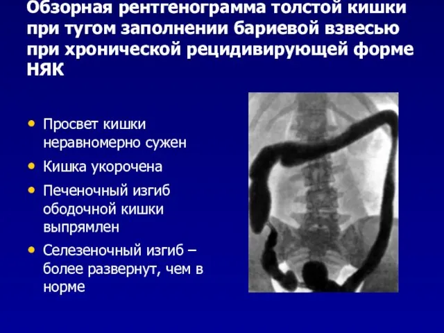 Обзорная рентгенограмма толстой кишки при тугом заполнении бариевой взвесью при хронической