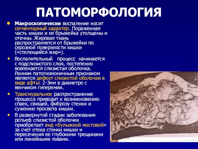 ПАТОМОРФОЛОГИЯ Макроскопически воспаление носит сегментарный характер. Пораженная часть кишки и ее