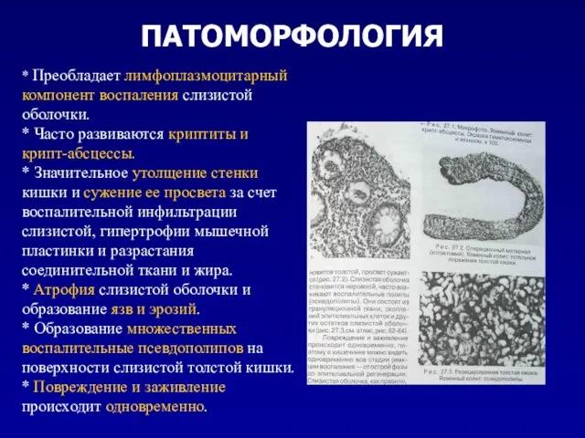 ПАТОМОРФОЛОГИЯ * Преобладает лимфоплазмоцитарный компонент воспаления слизистой оболочки. * Часто развиваются