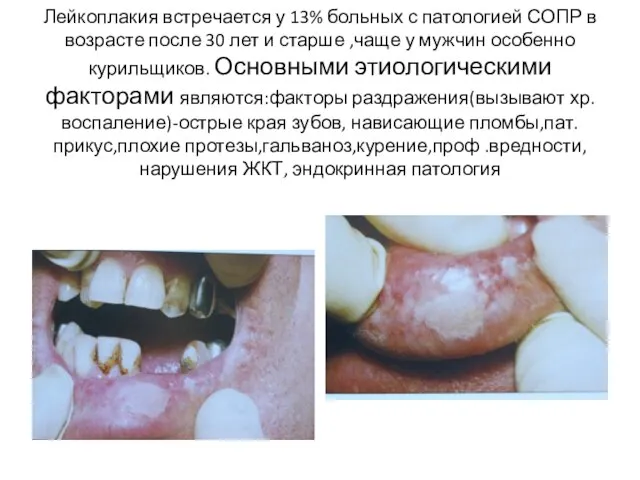 Лейкоплакия встречается у 13% больных с патологией СОПР в возрасте после