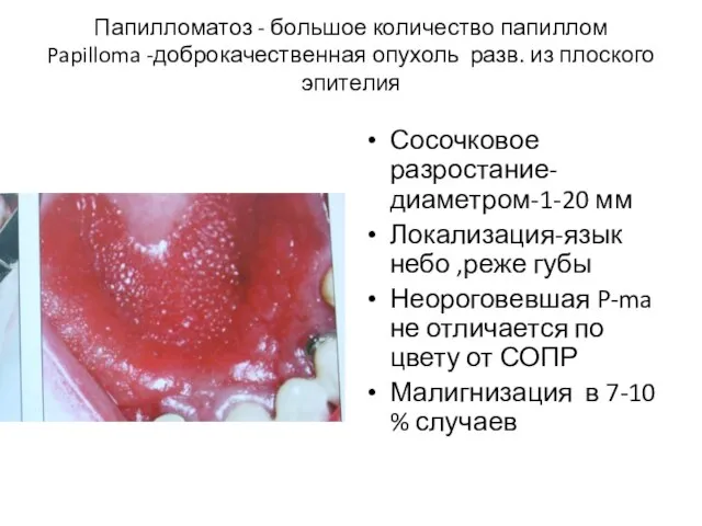 Папилломатоз - большое количество папиллом Papilloma -доброкачественная опухоль разв. из плоского