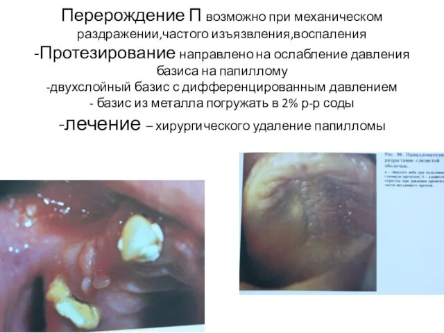 Перерождение П возможно при механическом раздражении,частого изъязвления,воспаления -Протезирование направлено на ослабление