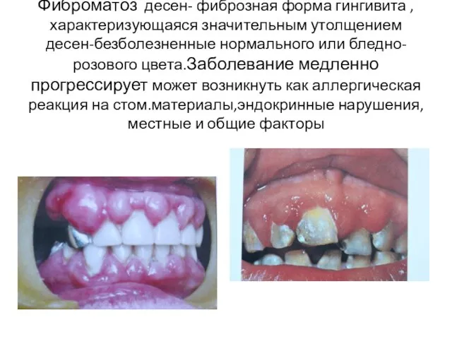 Фиброматоз десен- фиброзная форма гингивита ,характеризующаяся значительным утолщением десен-безболезненные нормального или