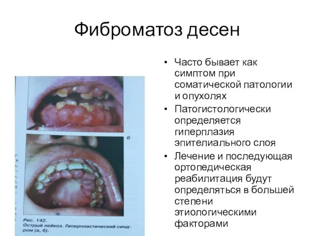 Фиброматоз десен Часто бывает как симптом при соматической патологии и опухолях