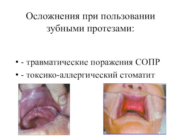 Осложнения при пользовании зубными протезами: - травматические поражения СОПР - токсико-аллергический стоматит