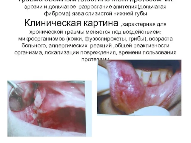 Травма съемным пластиночным протезом -мн.эрозии и дольчатое разростание эпителия(дольчатая фиброма)-язва слизистой
