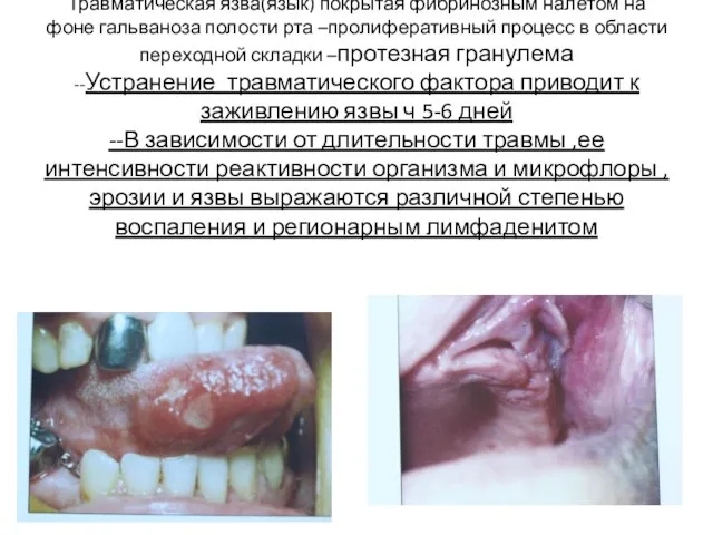 Травматическая язва(язык) покрытая фибринозным налетом на фоне гальваноза полости рта –пролиферативный