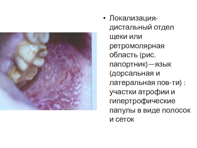 Локализация-дистальный отдел щеки или ретромолярная область (рис.папортник)—язык (дорсальная и латеральная пов-ти)